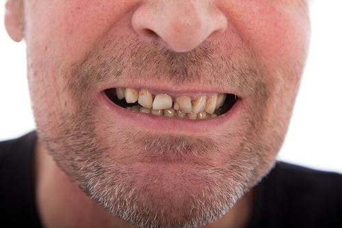 How Dental Plaque Increases Cancer Risk