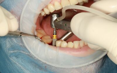 Best Tips and Care After Having Dental Implant Surgery